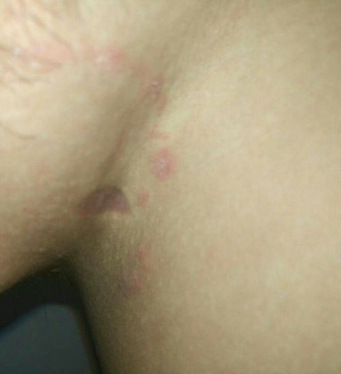 鱼鳞病会全身皮肤干燥吗 鱼鳞病会全身皮肤干燥吗