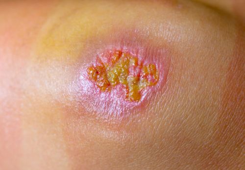 孕妇用了脚气喷雾怎么办 孕妇用了脚气喷雾怎么办