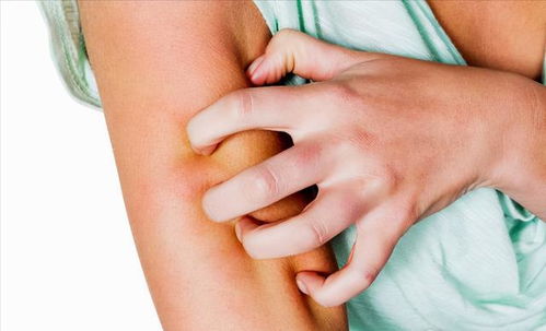 荨麻疹突然发紫怎么回事 荨麻疹突然发紫怎么回事