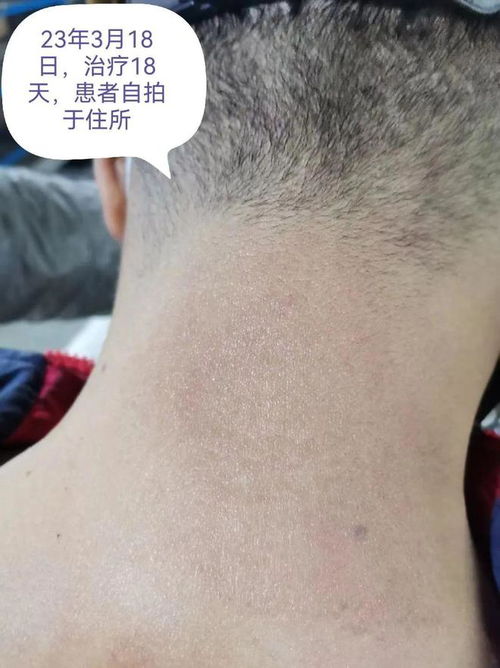 预防灰指甲的方法是什么呢 预防灰指甲的方法是什么呢