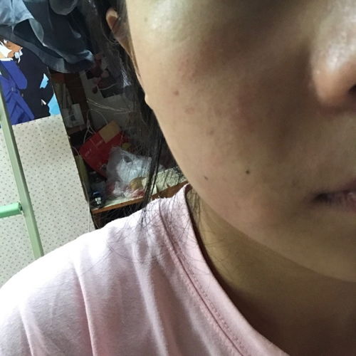 慢性荨麻疹能自愈吗 慢性荨麻疹能自愈吗