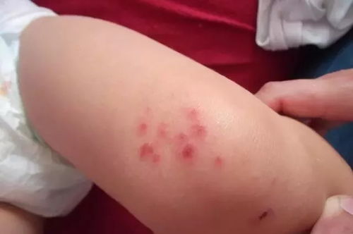 宝宝荨麻疹能打疫苗吗(宝宝荨麻疹什么样) 宝宝荨麻疹能打疫苗吗(宝宝荨麻疹什么样)