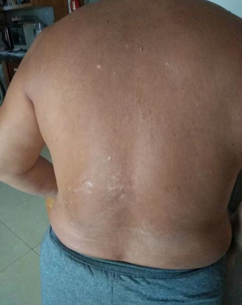 治疗荨麻疹的注意事项 治疗荨麻疹的注意事项